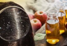 5 amazing benefits of using apple cider vinegar to treat dandruff